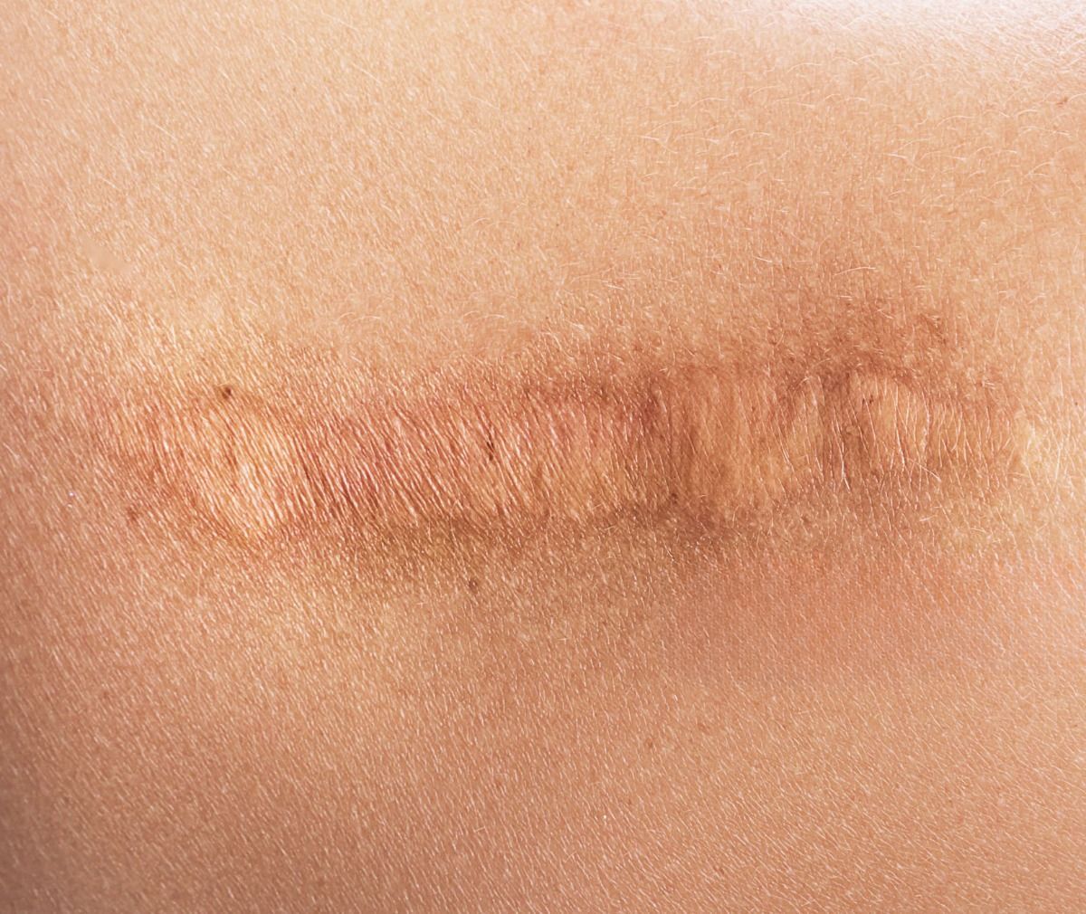 اسکار یا جای زخم چیست؟