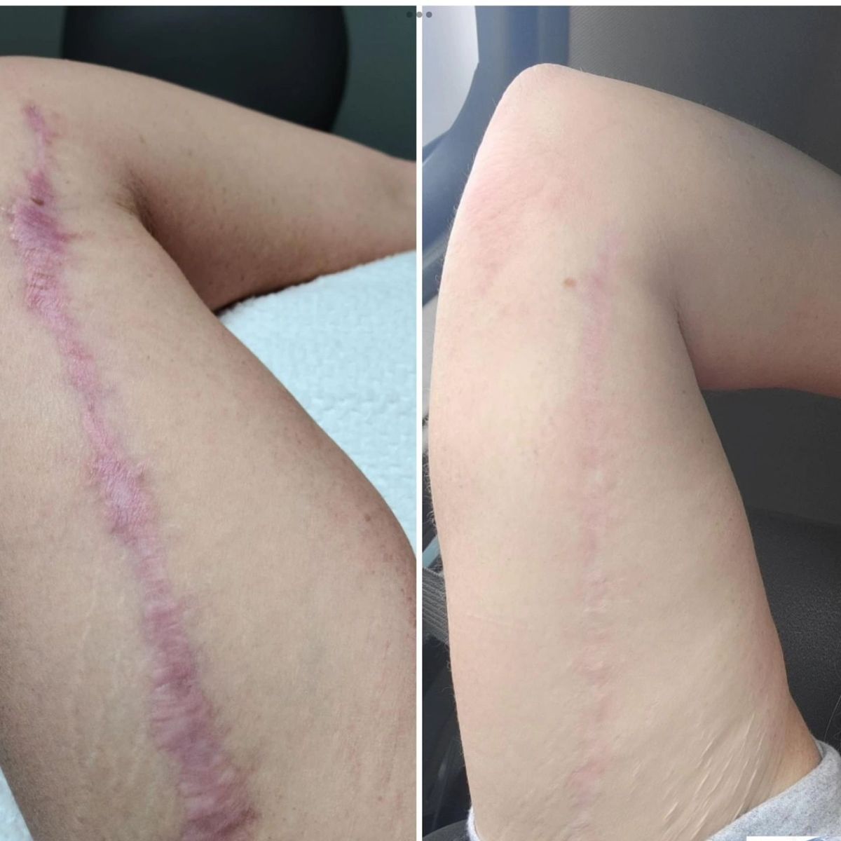 تفاوت کرم ها و پمادها در از بین بردن جای زخم